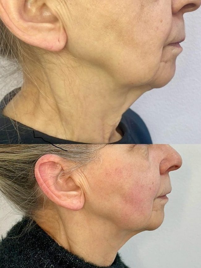 Bästa kliniken i Gärdet inom Fillers